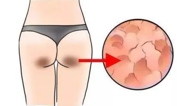 女生屁股后面的“黑印子”是什么？本文为你揭秘